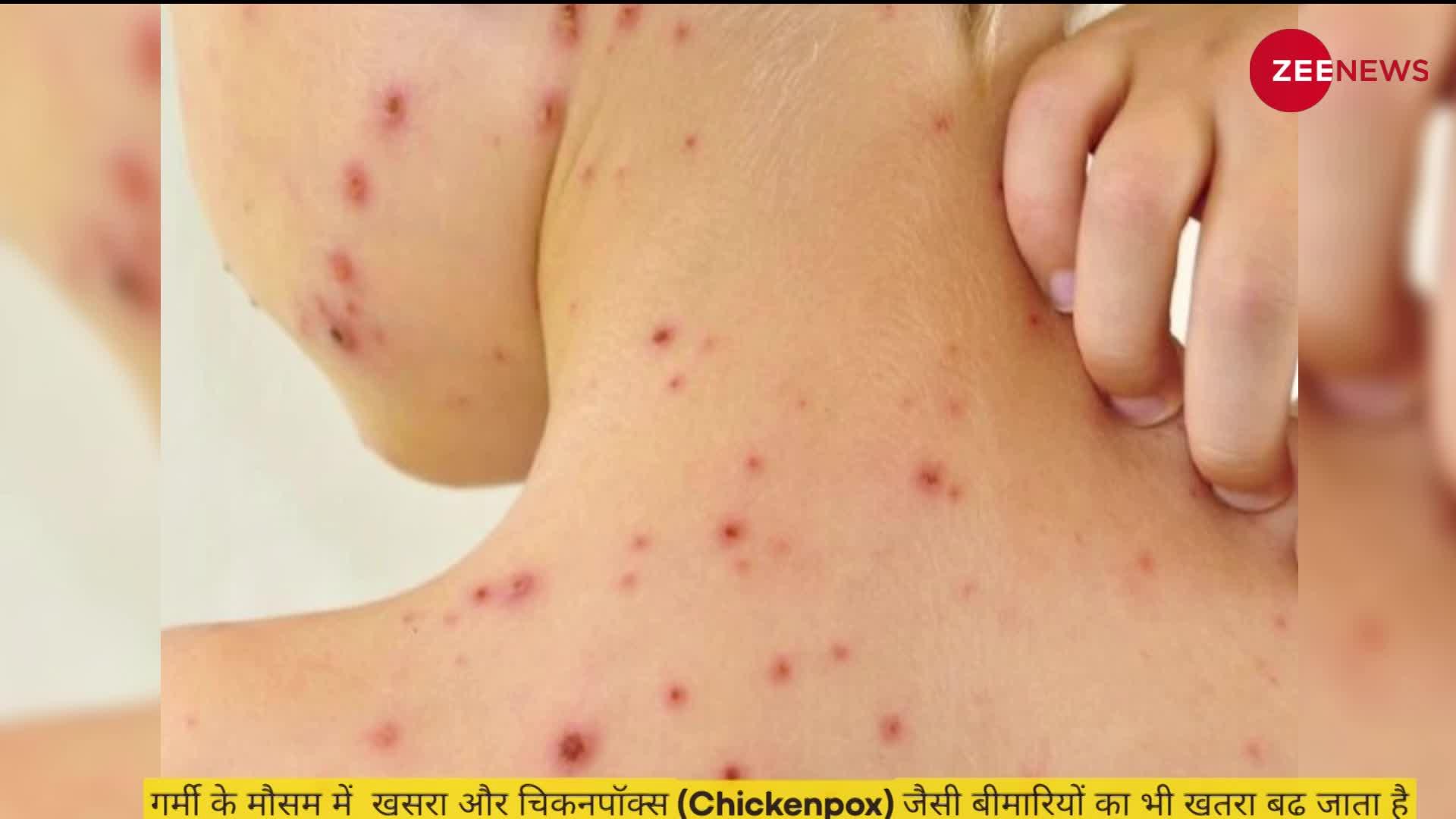 Summer Diseases:  गर्मियों के कराण हो सकती हैं इस तरह की बीमारियां, बचने के लिए अपनाएं ये उपाय