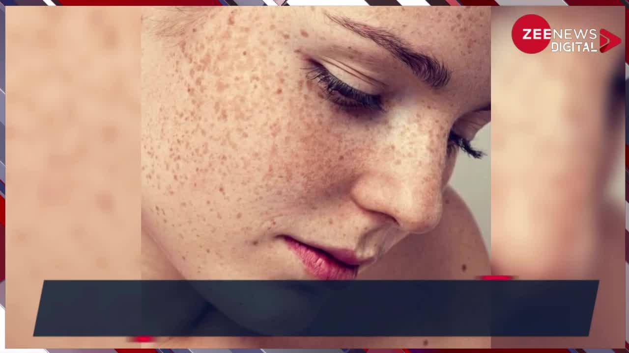 Home Remedies For Dark Spots: काले दाग से पाना हो छुटकारा तो अपनाएं ये घरेलू उपाय