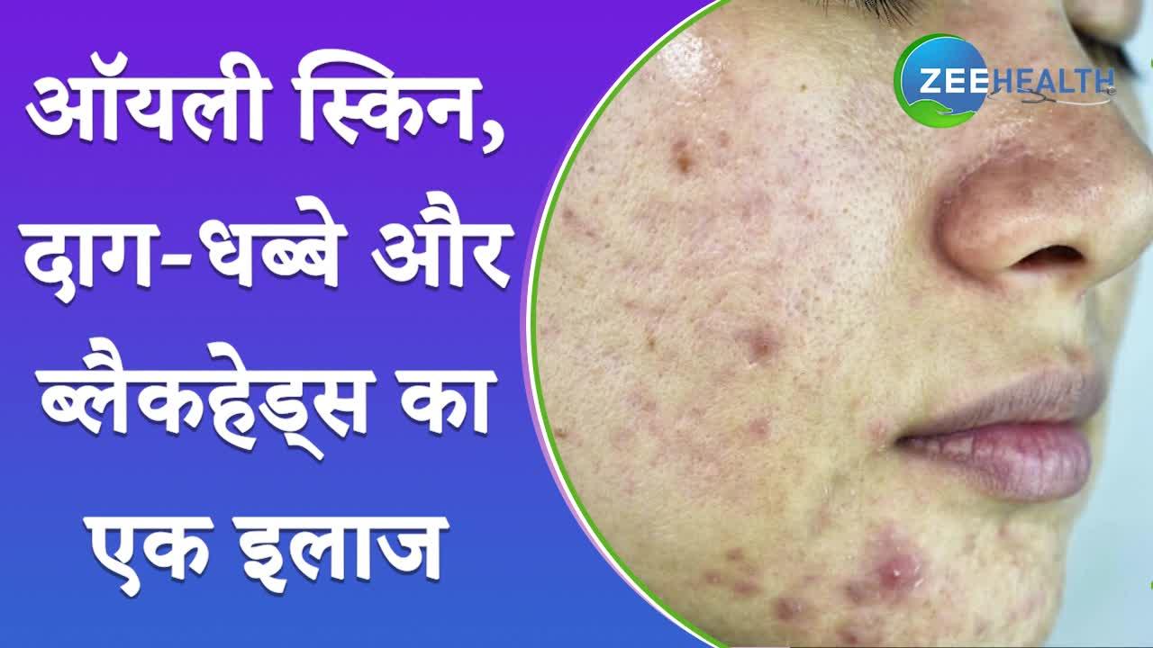 ऑयली स्किन, दाग-धब्बे और ब्लैकहेड्स जैसी सभी Skin Problems का एक ही इलाज, जानें यहां